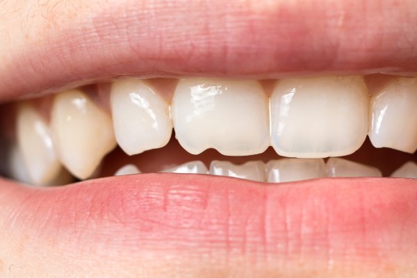 man smiling in dentists chair