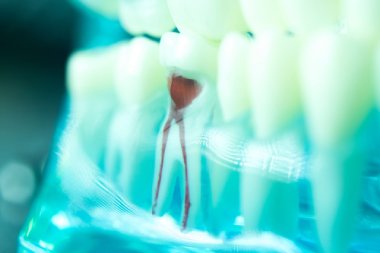 root-canal-treatment